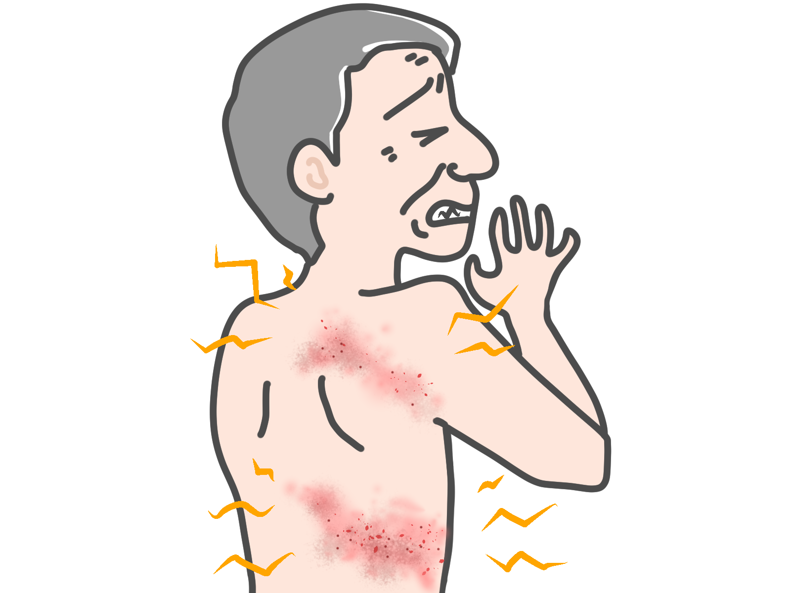 帯状疱疹の症状